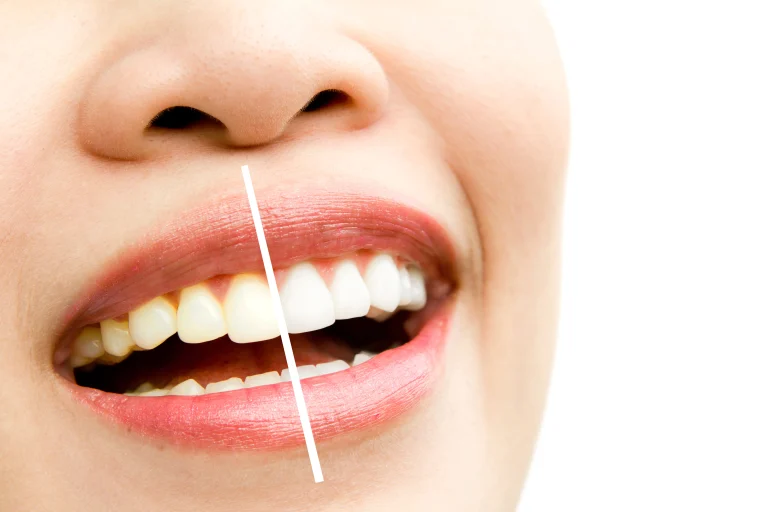 photo showing the difference in colour of teeth after doing dental whitening treatment
