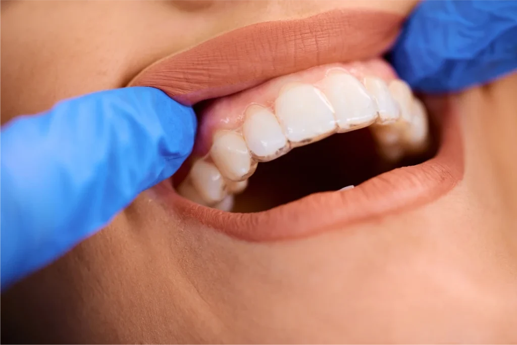 a women putting on an Invisalign teeth aligner